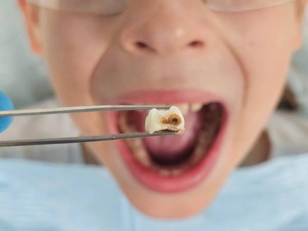 Best Emergency Dental Care for Abscessed Tooth in Parsons, WV